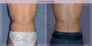 Before and after image of a liposculpture procedure.
